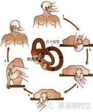 耳石症的手法复位视频,耳石症手法复位操作步骤详解